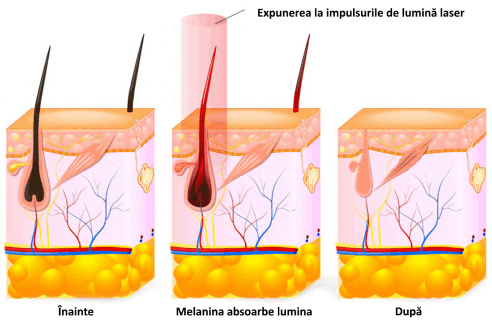 Epilare Definitivă