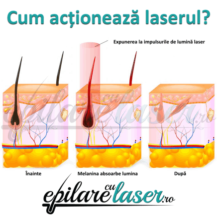 Ce este epilarea progresiv definitivă cu laser diode 808 nm